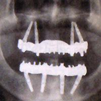 �I�[���I��4�@CT�摜