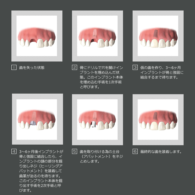 �C���v�����g�̎��Â̗���